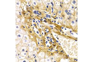 Immunohistochemistry of paraffin-embedded human liver injury using CFH antibody (ABIN5971193) at dilution of 1/200 (40x lens). (Complement Factor H antibody)