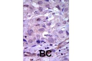 Formalin-fixed and paraffin-embedded human cancer tissue reacted with the primary antibody, which was peroxidase-conjugated to the secondary antibody, followed by AEC staining. (Ret Proto-Oncogene antibody  (N-Term))