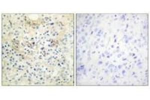 Immunohistochemistry analysis of paraffin-embedded human prostate carcinoma tissue, using TM16G antibody. (Anoctamin 7 antibody  (C-Term))
