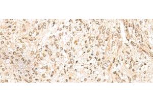 Immunohistochemistry of paraffin-embedded Human liver cancer tissue using MDFI Polyclonal Antibody at dilution of 1:55(x200) (MDFI antibody)