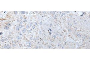 Immunohistochemistry of paraffin-embedded Human esophagus cancer tissue using RASA1 Polyclonal Antibody at dilution of 1:40(x200) (RASA1 antibody)