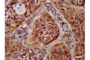 IHC image of ABIN7147960 diluted at 1:300 and staining in paraffin-embedded human cervical cancer performed on a Leica BondTM system. (ST3GAL4 antibody  (AA 39-184))