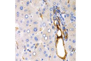 Immunohistochemistry of paraffin-embedded 人human liver cancer using TFF1 antibody at dilution of 1:200 (400x lens). (TFF1 antibody)
