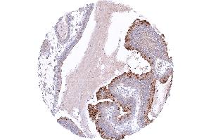 Gastric adenocarcinoma of the fundic gland type with distinct pepsinogen I staining of tumor cells (Recombinant Pepsinogen A antibody)