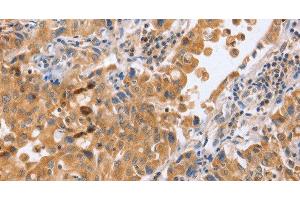 Immunohistochemistry of paraffin-embedded Human lung cancer tissue using BLNK Polyclonal Antibody at dilution 1:50 (B-Cell Linker antibody)
