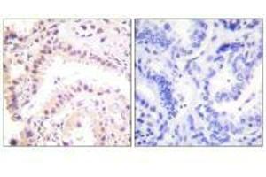 Immunohistochemical analysis of paraffin-embedded human lung carcinoma tissue using Cullin 2 antibody. (Cullin 2 antibody)