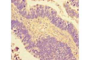 Immunohistochemistry of paraffin-embedded human ovarian cancer using ABIN7148641 at dilution of 1:100 (NR2F2 antibody  (AA 123-383))