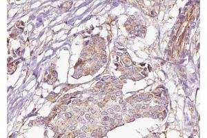 ABIN6273030 at 1/100 staining Human breast cancer tissue by IHC-P.