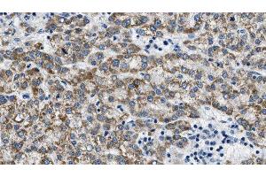 ABIN6275386 at 1/100 staining Human liver cancer tissue by IHC-P. (KCNQ4 antibody  (C-Term))