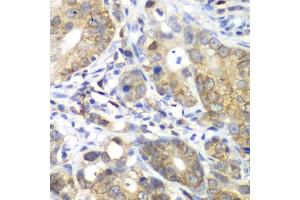 Immunohistochemistry of paraffin-embedded human gastric cancer using CDK1 antibody (ABIN6134274, ABIN6138303, ABIN6138304 and ABIN6219543) at dilution of 1:100 (40x lens). (CDK1 antibody  (AA 208-258))