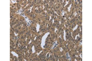 Immunohistochemistry of Human lung cancer using PRKAR1B Polyclonal Antibody at dilution of 1:60