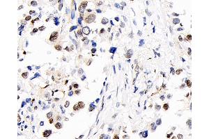 Immunohistochemistry analysis of paraffin-embedded human lung cancer using S100A4 Polyclonal Antibody at dilution of 1:400. (s100a4 antibody)