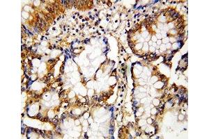 IHC-P: Caspase-10 antibody testing of human intestinal cancer  tissue (Caspase 10 antibody  (AA 220-236))