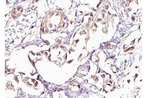 ABIN6276703 at 1/100 staining Human breast cancer tissue by IHC-P. (PICK1 antibody  (N-Term))