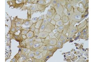 Immunohistochemistry of paraffin-embedded human breast cancer using GGT1 antibody (ABIN3022526, ABIN3022527, ABIN3022528 and ABIN6218881) at dilution of 1:100 (40x lens). (GGT1 antibody  (AA 370-569))
