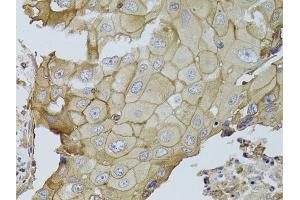 Immunohistochemistry of paraffin-embedded human breast cancer using GGT1 antibody (ABIN3022526, ABIN3022527, ABIN3022528 and ABIN6218881) at dilution of 1:100 (40x lens). (GGT1 antibody  (AA 370-569))