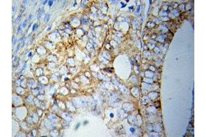 Immunohistochemistry of paraffin-embedded Prostate cancer using HSPA5 antibody. (GRP78 antibody  (AA 550-650))