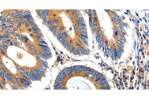 Immunohistochemistry of paraffin-embedded Human colon cancer tissue using IGFBP7 Polyclonal Antibody at dilution 1:50 (IGFBP7 antibody)