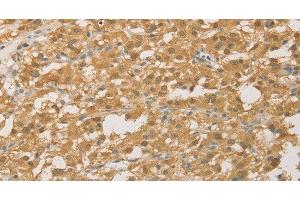 Immunohistochemistry of paraffin-embedded Human thyroid cancer using PGK2 Polyclonal Antibody at dilution of 1:50 (PGK2 antibody)