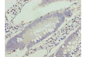 Immunohistochemistry of paraffin-embedded human colon cancer using ABIN7175336 at dilution of 1:100 (VPS25 antibody  (AA 1-176))