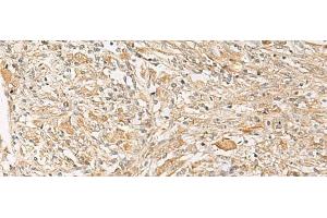 Immunohistochemistry of paraffin-embedded Human liver cancer tissue using GPR22 Polyclonal Antibody at dilution of 1:50(x200) (GPR22 antibody)