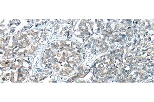 Immunohistochemistry of paraffin-embedded Human esophagus cancer tissue using COMMD6 Polyclonal Antibody at dilution of 1:45(x200) (COMMD6 antibody)