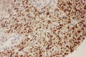 Anti-P53 Picoband antibody,  IHC(P): Human Lung Cancer Tissue (p53 antibody  (AA 74-393))