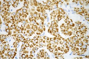 Immunohistochemistry was performed on paraffin-embedded human hepatocarcinoma using carbamoyl-phosphate synthase 1 antibody (ABIN7797865), 1:200).