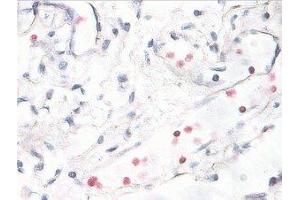 Immunostaining of human breast cancer tissue showing p38 when phosphorylated at Thr180/Tyr182 in red. (MAPK14 antibody  (pThr180, pTyr182))