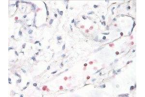 Immunostaining of human breast cancer tissue showing p38 when phosphorylated at Thr180/Tyr182 in red. (MAPK14 antibody  (pThr180, pTyr182))
