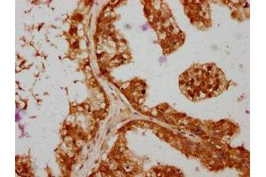 IHC image of ABIN7166095 diluted at 1:364 and staining in paraffin-embedded human prostate cancer performed on a Leica BondTM system. (SAV1 antibody  (AA 1-210))