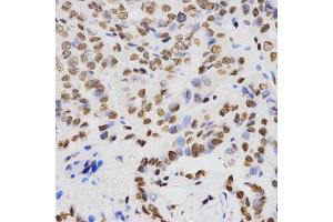 Immunohistochemistry of paraffin-embedded human thyroid cancer tissue using H4K20me2 antibody at dilution of 1:200 (x400 lens). (Histone H4 antibody  (2meLys20))
