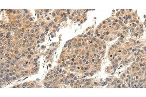 Immunohistochemistry of paraffin-embedded Human liver cancer tissue using SLC27A1 Polyclonal Antibody at dilution 1:40 (SLC27A1 antibody)