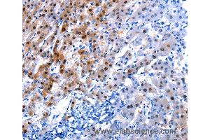 Immunohistochemistry of Human liver cancer using IL2RA Polyclonal Antibody at dilution of 1:30 (CD25 antibody)