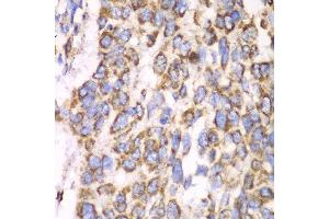 Immunohistochemistry of paraffin-embedded human esophageal cancer using ATP5A1 antibody at dilution of 1:100 (x40 lens). (ATP5A1 antibody)