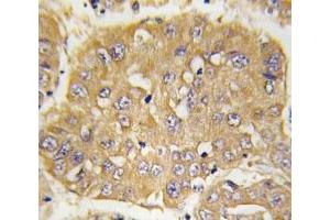 IHC analysis of FFPE human hepatocarcinoma tissue stained with IGFBP3 antibody (IGFBP3 antibody  (AA 163-193))