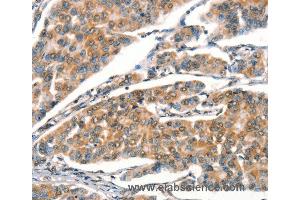 Immunohistochemistry of Human breast cancer using STK17A  Polyclonal Antibody at dilution of 1:25 (STK17A antibody)