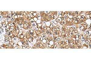 Immunohistochemistry of paraffin-embedded Human liver cancer tissue using PHLDA3 Polyclonal Antibody at dilution of 1:110(x200) (PHLDA3 antibody)