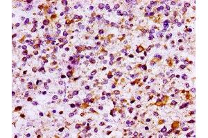 IHC image of ABIN7156768 diluted at 1:100 and staining in paraffin-embedded human glioma performed on a Leica BondTM system. (IL1R2 antibody  (AA 79-219))