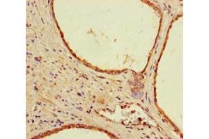 Immunohistochemistry of paraffin-embedded human prostate cancer using ABIN7142194 at dilution of 1:100 (26S Proteasome Complex Subunit SEM1 (SEM1) (AA 1-70) antibody)