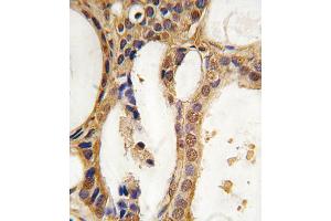 Formalin-fixed and paraffin-embedded human prostata carcinoma tissue reacted with PIM1 antibody, which was peroxidase-conjugated to the secondary antibody, followed by DAB staining. (PIM1 antibody)