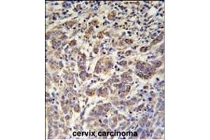ANKRD57 Antibody (C-term) (ABIN651987 and ABIN2840483) immunohistochemistry analysis in formalin fixed and paraffin embedded human cervix carcinoma followed by peroxidase conjugation of the secondary antibody and DAB staining. (ANKRD57 antibody  (C-Term))