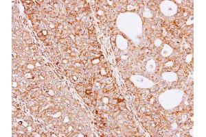 IHC-P Image Immunohistochemical analysis of paraffin-embedded Serous OVCA xenograft, using THUMPD3, antibody at 1:100 dilution. (THUMPD3 antibody)