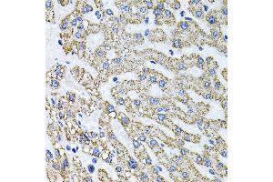 Immunohistochemistry of paraffin-embedded human liver damage using SDC2 antibody (ABIN3022587, ABIN3022588, ABIN3022589 and ABIN6218928) at dilution of 1:100 (40x lens).