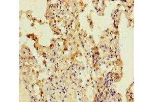 Immunohistochemistry of paraffin-embedded human lung cancer using ABIN7148108 at dilution of 1:100 (C12ORF68 antibody  (AA 1-194))