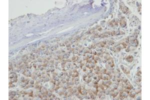 IHC-P Image Immunohistochemical analysis of paraffin-embedded Hep3B xenograft, using PRPS2, antibody at 1:100 dilution. (PRPS2 antibody)
