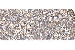 Immunohistochemistry of paraffin-embedded Human lung cancer tissue using KRT73 Polyclonal Antibody at dilution of 1:55(x200) (KRT73 antibody)