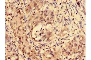 Immunohistochemistry of paraffin-embedded human liver cancer using ABIN7158369 at dilution of 1:100 (LIM Domain Binding 1 Protein antibody  (AA 50-375))