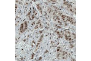 Immunohistochemical staining (Formalin-fixed paraffin-embedded sections) of human breast cancer with WHSC1 monoclonal antibody, clone CL1057  shows moderate nuclear immunoreactivity in tumor cells. (WHSC1 antibody)