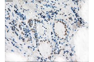 Immunohistochemical staining of paraffin-embedded Adenocarcinoma of colon tissue using anti-XRCC4mouse monoclonal antibody. (XRCC4 antibody)